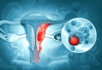 Pembrolizumab Aids Survival With High-Risk Endometrial Cancer