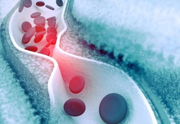 Prevalence of High Total Cholesterol 11.3 Percent in U.S. Adults