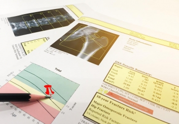 RSNA: Levotiroxina associada à perda óssea ao longo do tempo em adultos mais velhos