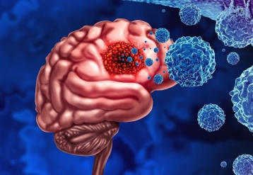 Tumor-Related Epilepsy Not Strong Prognostic Factor in Diffuse Glioma