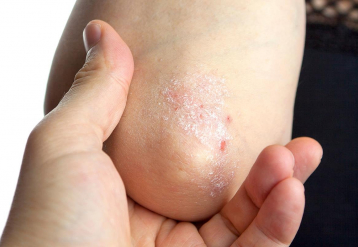 Plant-Based Diets May Aid Symptoms of Psoriasis