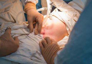 How to Gauge Your Personal Risk For a Hernia