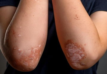 AAD: Zasocitinib Safe, Effective for Moderate-to-Severe Plaque Psoriasis in Adults