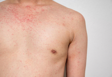 First Measles Case of the Year Reported in New Jersey