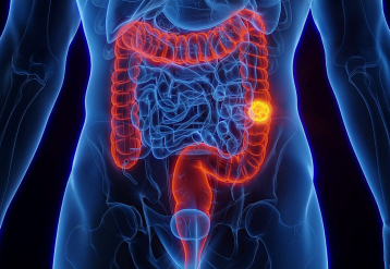 ACS Updates CRC Screening Guidelines to Incorporate Newer Screening Methods