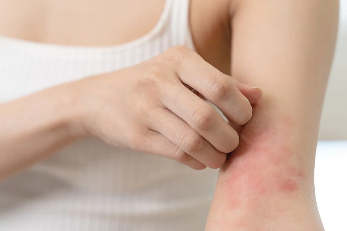 Új kezelések ajánlottak az atópiás dermatitisz kezelésére felnőtteknél