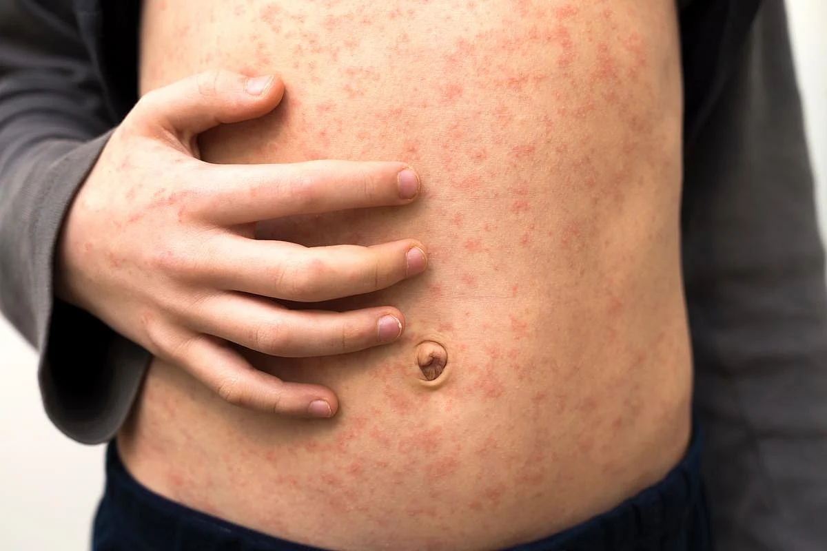 L'epidemia di morbillo in Texas è finito dopo centinaia di infetti e 2 morti